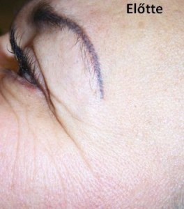 mezoterápia_előtte