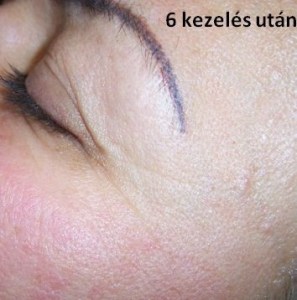 mezoterápia_utána